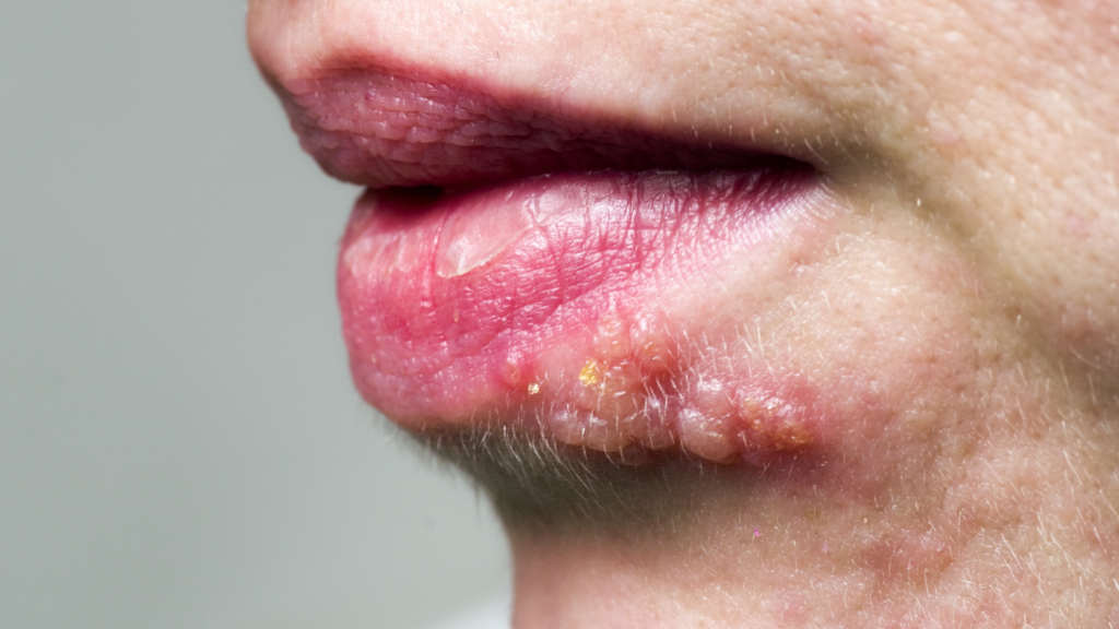 vírus herpes simplex tipo 1 / HSV-1