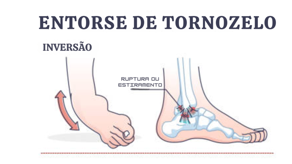 entorse de tornozelo