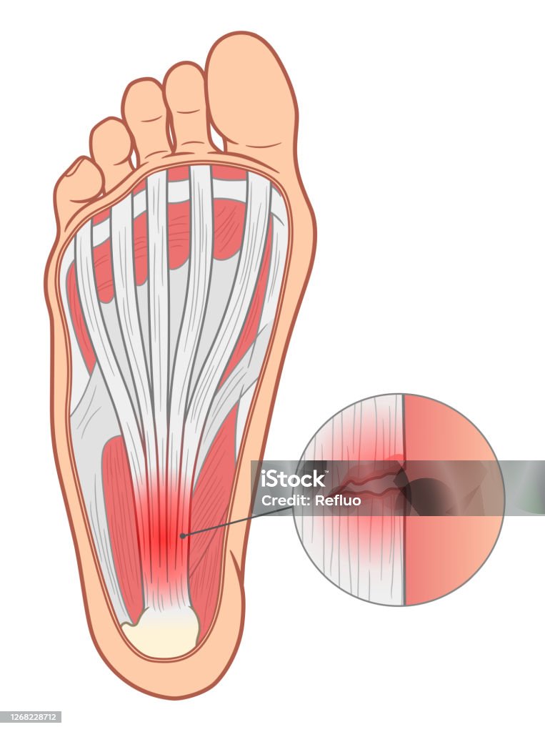 Fáscia plantar inflamada