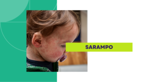 sarampo